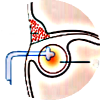  Abscess Pelvic Treatment